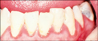 Gingivitis