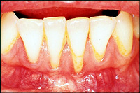 Advanced periodontitis