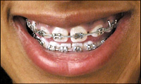 Metal Braces