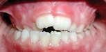 Crossbite (orthodontic example)