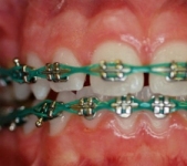Power Chain (orthodontic example)