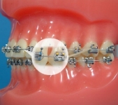 Archwire (orthodontic example)