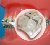 Bracket (orthodontic example)