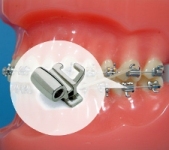 Buccal Tube (orthodontic example)
