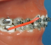 Rubber Bands (orthodontic example)