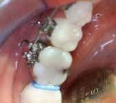 Separators (orthodontic example)